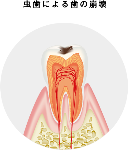 虫歯による歯の崩壊