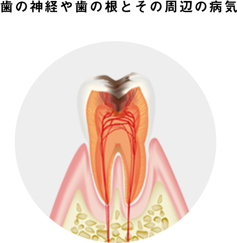 歯の神経や歯の根とその周辺の病気