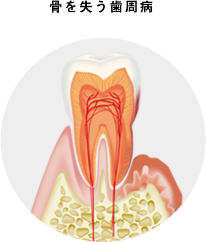 骨を失う歯周病